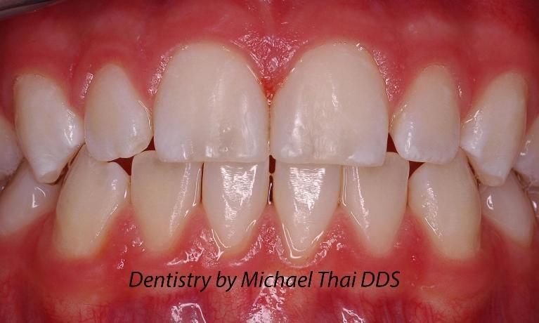 Anterior-Composite-Tooth-Colored-Filling-After-Image
