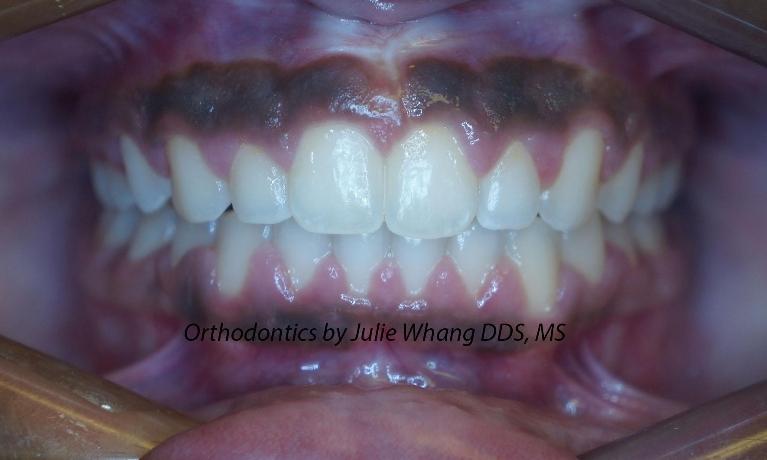 Orthodontics-After-Image