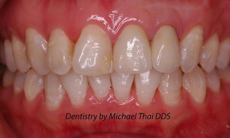 Esthetic-Crowns-After-Image