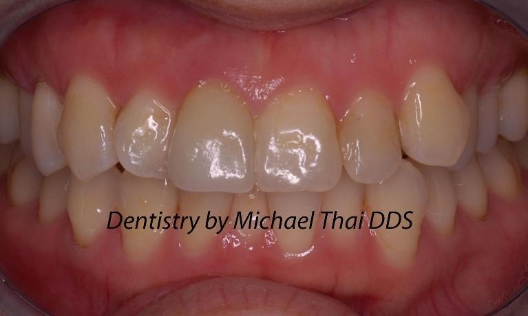 Anterior-Crown-After-Image