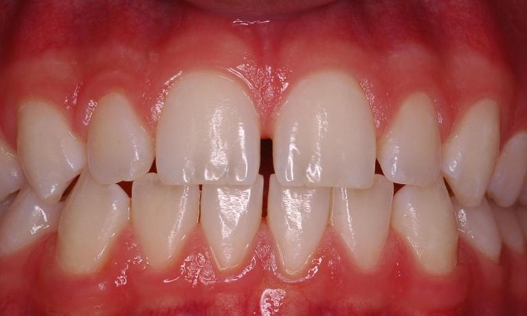 Anterior-Composite-Tooth-Colored-Filling-Before-Image