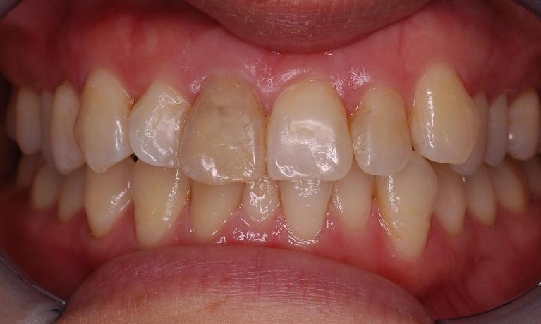 Anterior-Crown-Before-Image