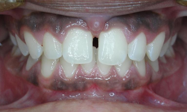 Orthodontics-Before-Image
