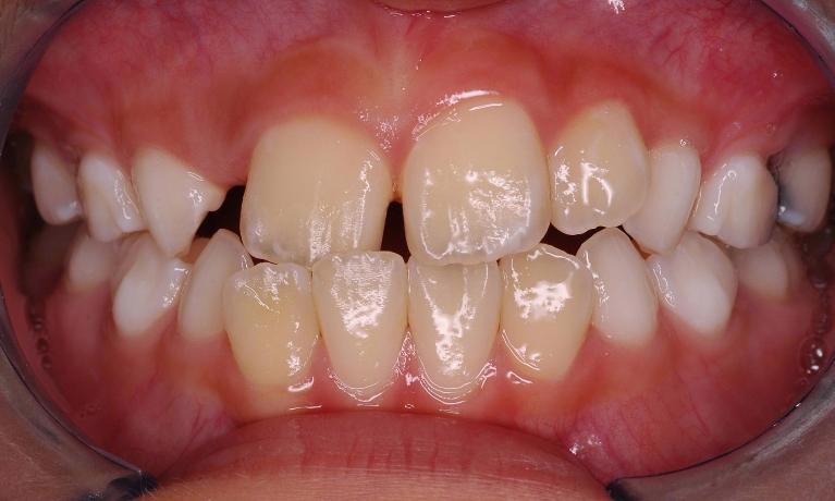 Phase-I-Before-Image