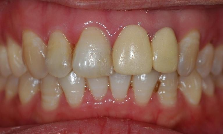 Esthetic-Crowns-Before-Image